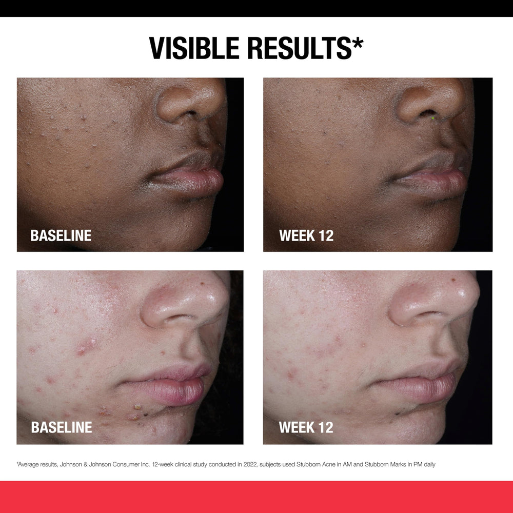 Neutrogena Stubborn Marks PM Treatment night-time routine image suggests pairing with AM treatment.