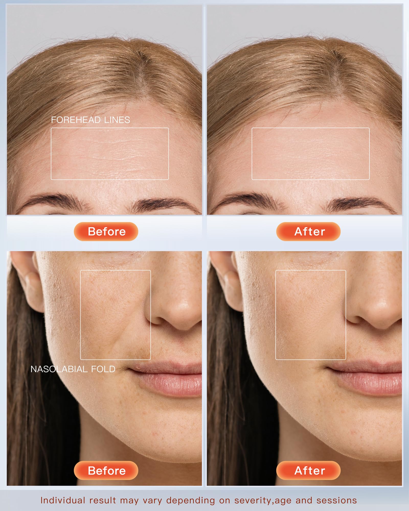 NEWKEY LED Face Mask blue light close-up targeting acne-prone areas