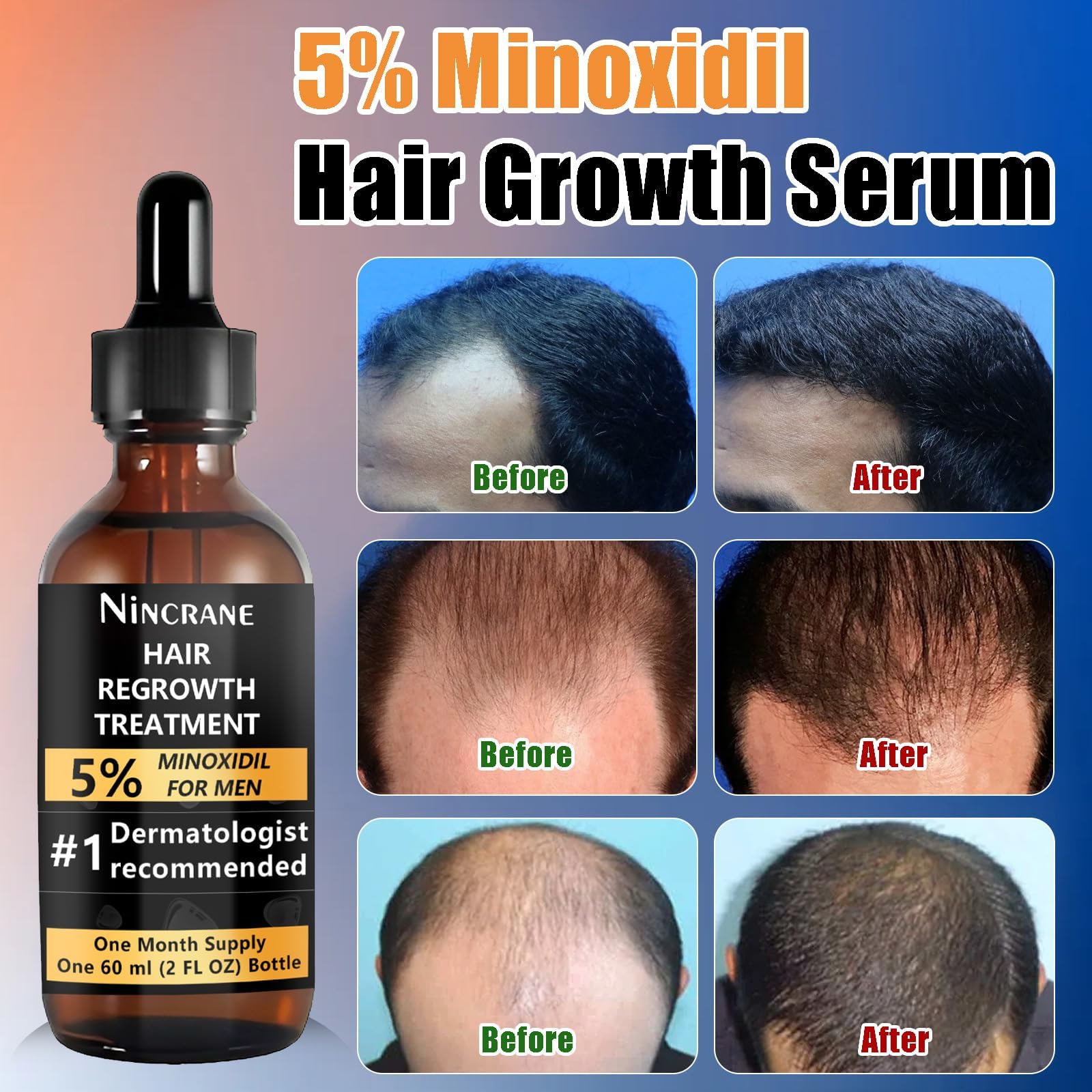 Nincrane Minoxidil 5% dropper for precise beard growth application.