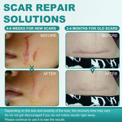 Nullam silicone scar tape rolled for application image emphasizes easy to apply strips