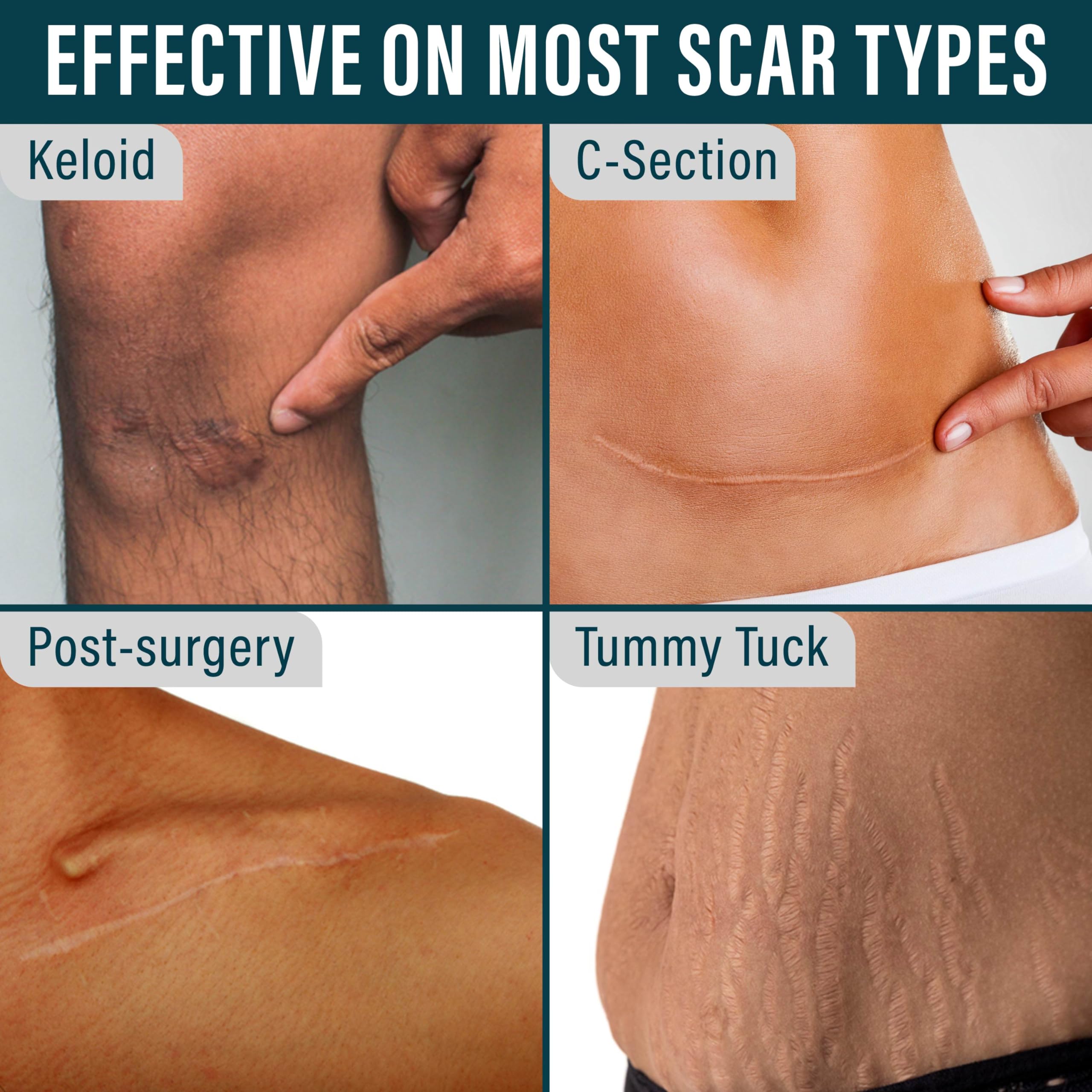 NUVADERMIS silicone scar tape breathable material closeup emphasizes comfortable wear against sensitive skin.