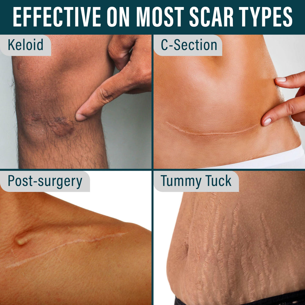 NUVADERMIS silicone scar tape breathable material closeup emphasizes comfortable wear against sensitive skin.
