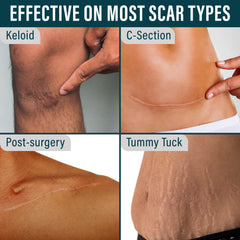 NUVADERMIS silicone scar tape breathable material closeup emphasizes comfortable wear against sensitive skin.