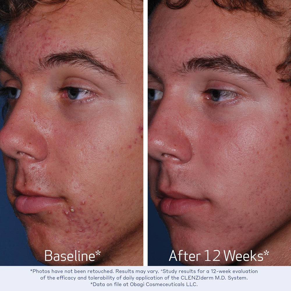 Obagi CLENZIderm M.D. 2% salicylic acid targets pore care and exfoliation