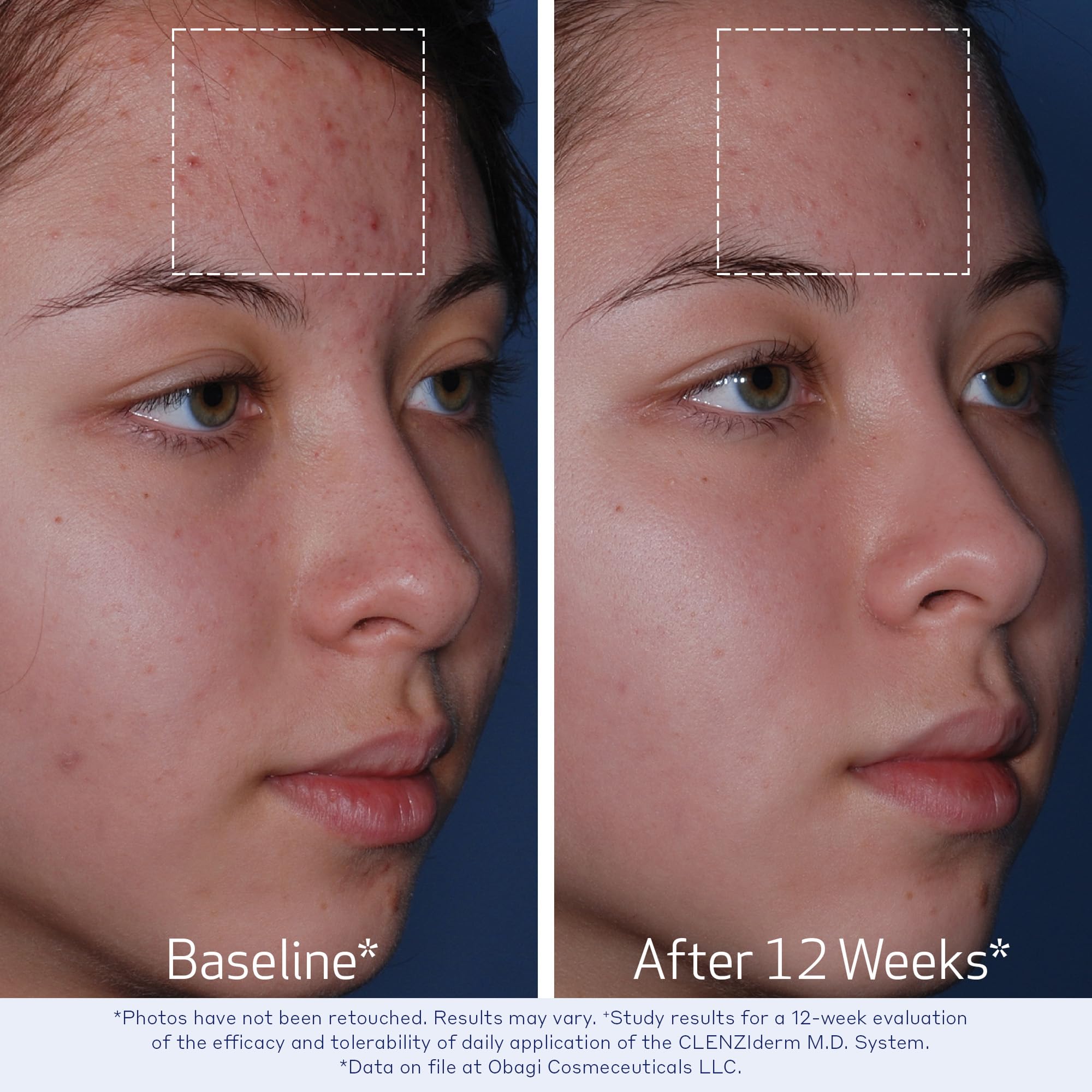 Obagi CLENZIderm MD Foaming Cleanser lathers richly for a refreshing cleanse morning or night.
