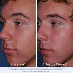 Obagi CLENZIderm MD toner liquid on cotton pad for gentle exfoliation.