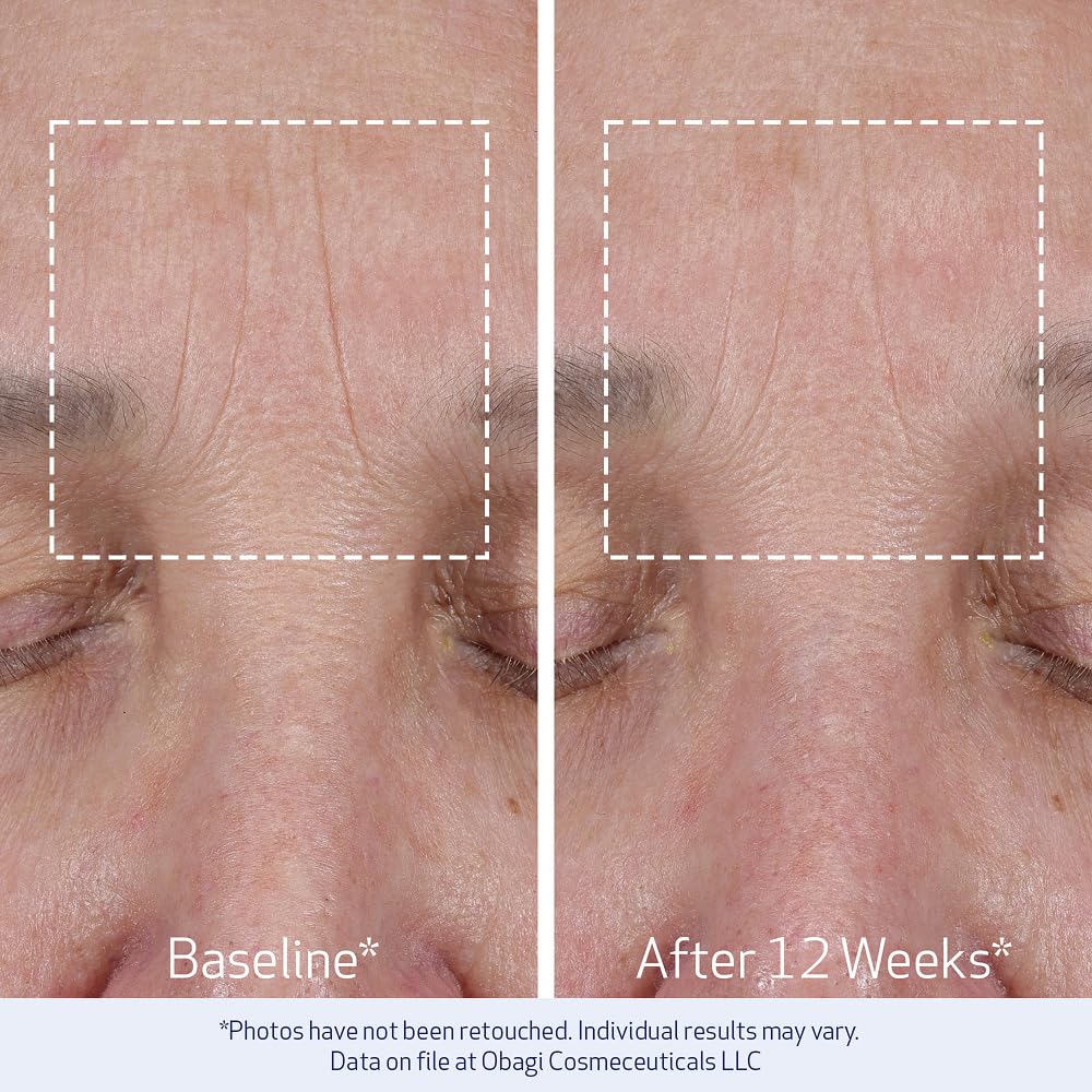 Obagi ELASTIderm clinical results after 6 weeks showing fine line improvement