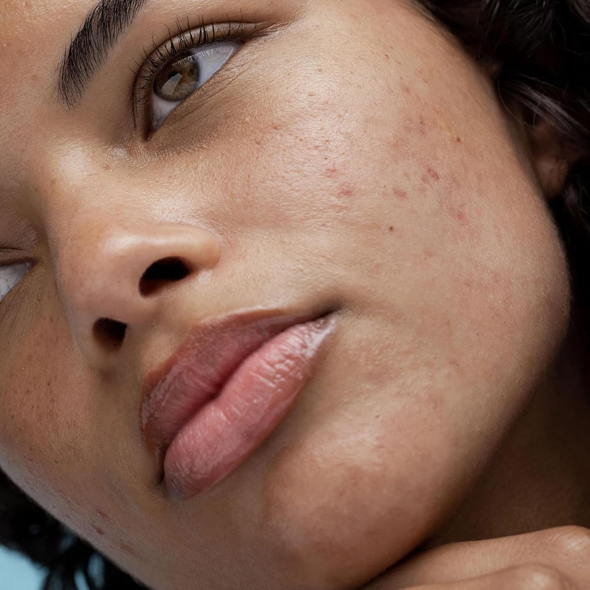 Obagi Rebalance skin close-up illustrating gentle formula for eczema-prone areas.