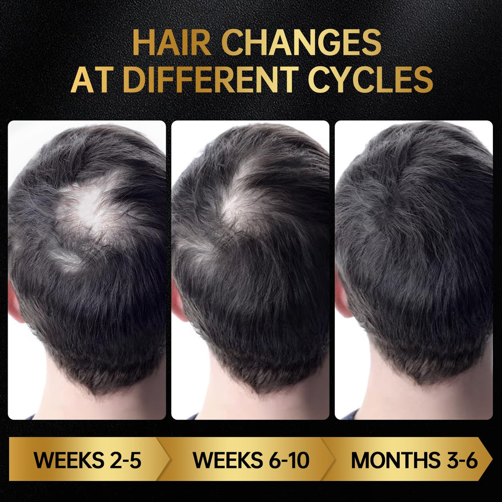 OCSINL Minoxidil with biotin suggests added nutrients for hair support.