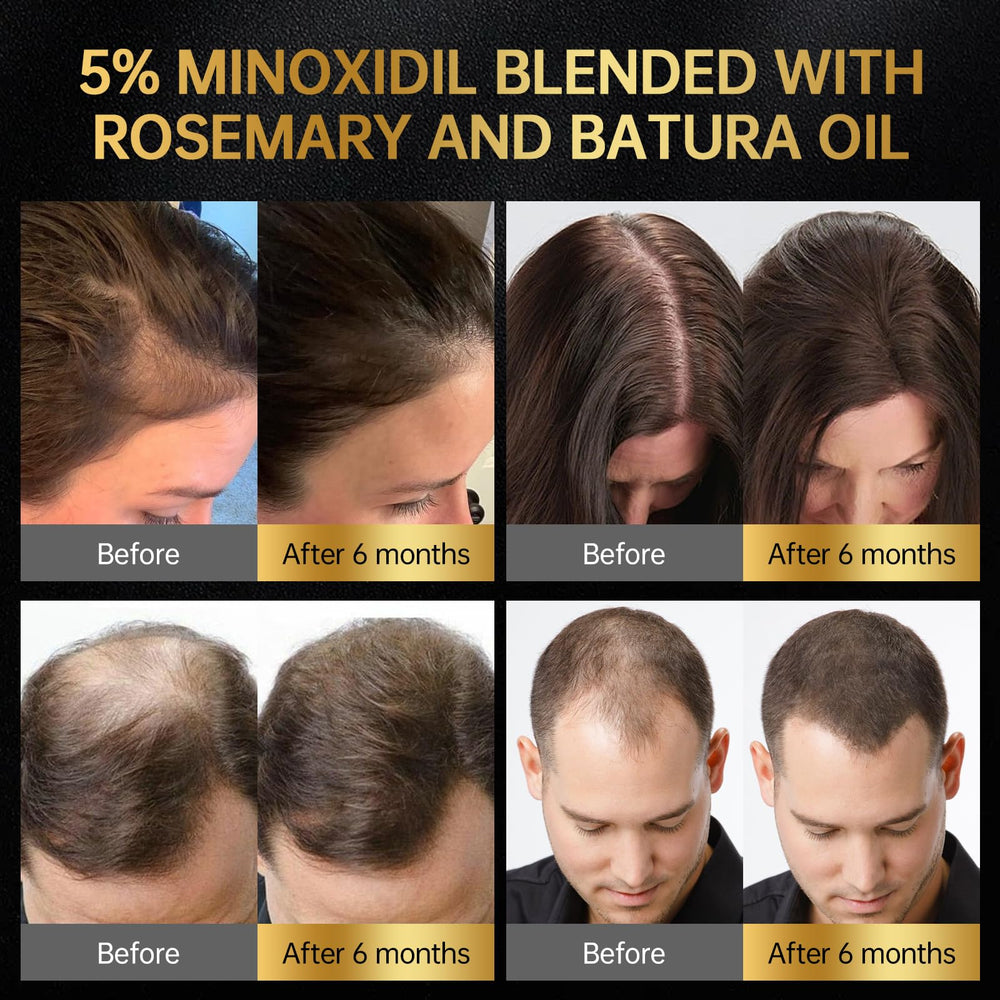 OCSINL Minoxidil massage tip reaching roots during daily use.