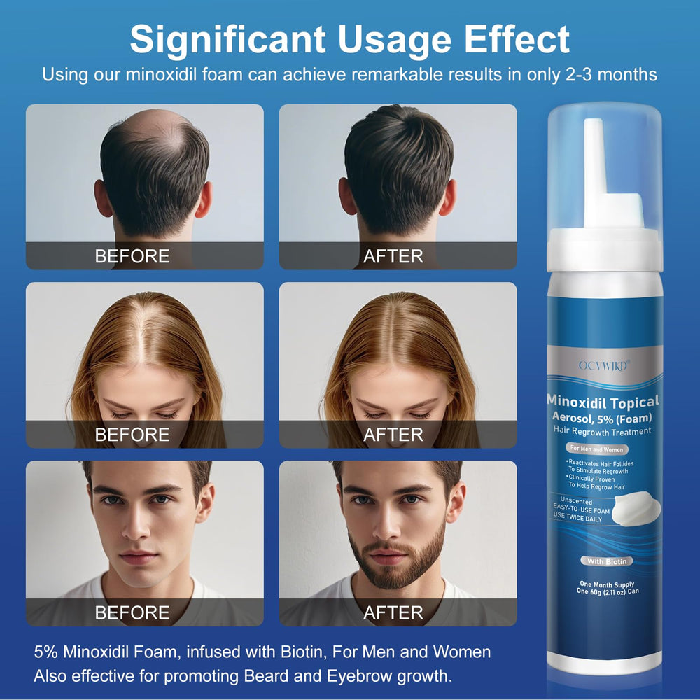 OCVWJKD biotin-infused minoxidil foam closeup promotes healthier hair growth