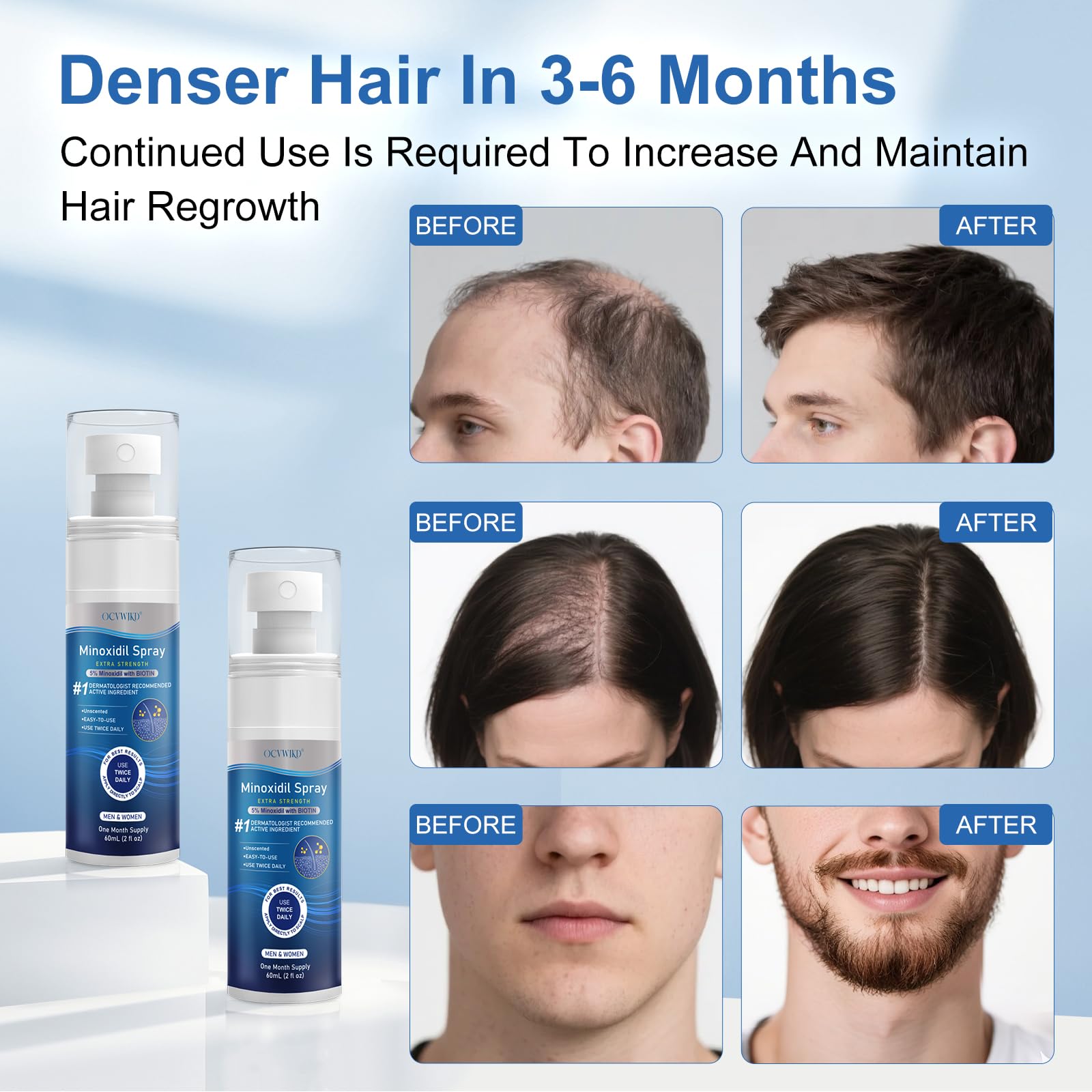 OCVWJKD minoxidil growth-area application demonstrates hair regrowth in treated zones