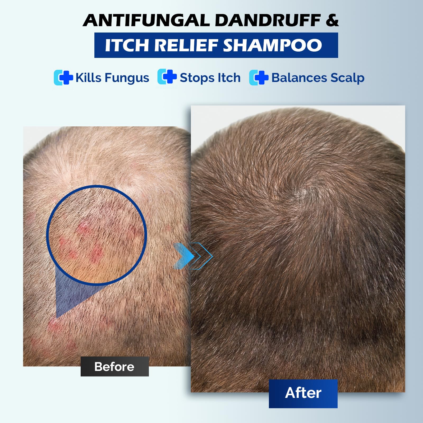 Oely scalp psoriasis soothing shampoo image promises calmer scalp.