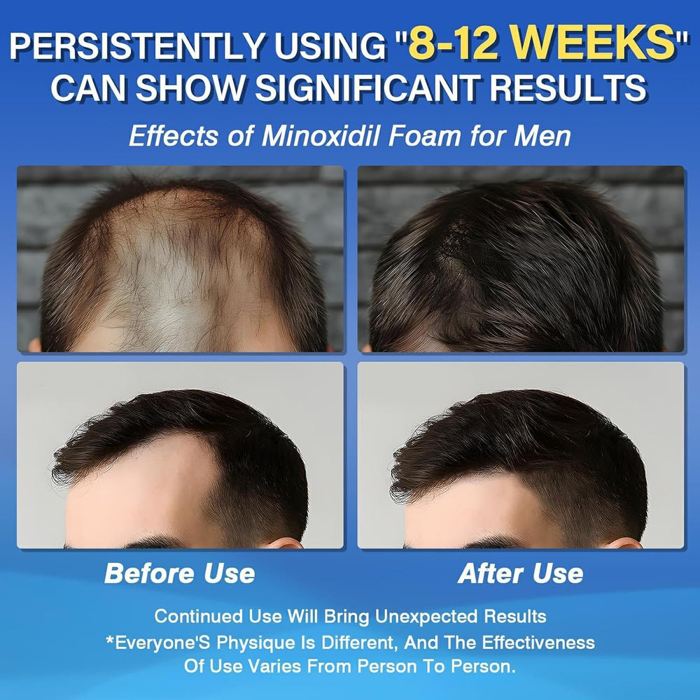 Olassubd Minoxidil 5% foam application area demonstrates targeted hair support.