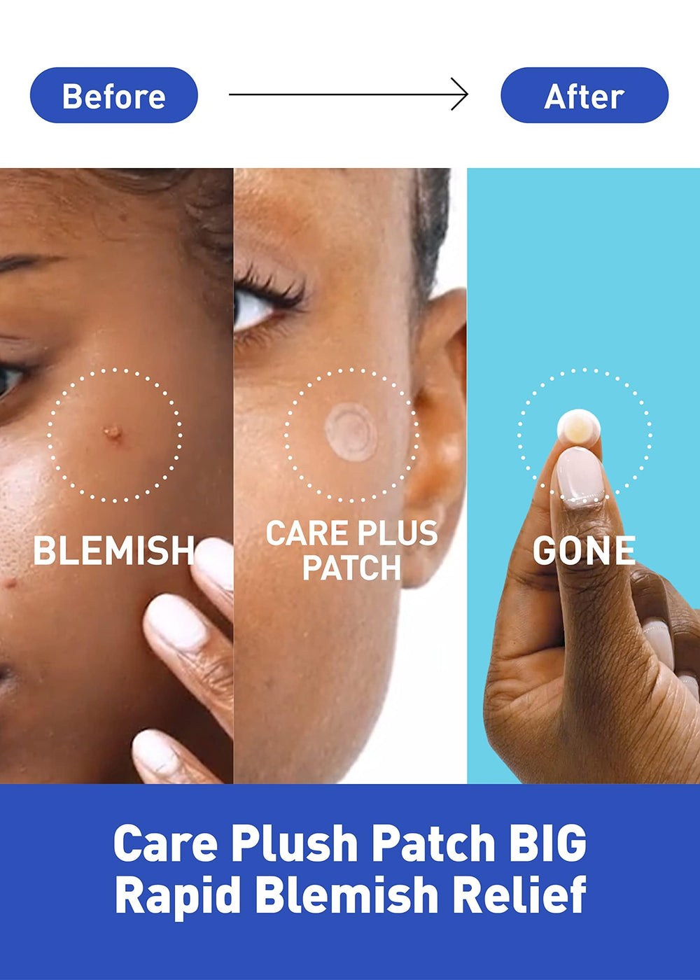OLIVE YOUNG Care Plus Spot Patch demonstrates transparent adhesive on skin