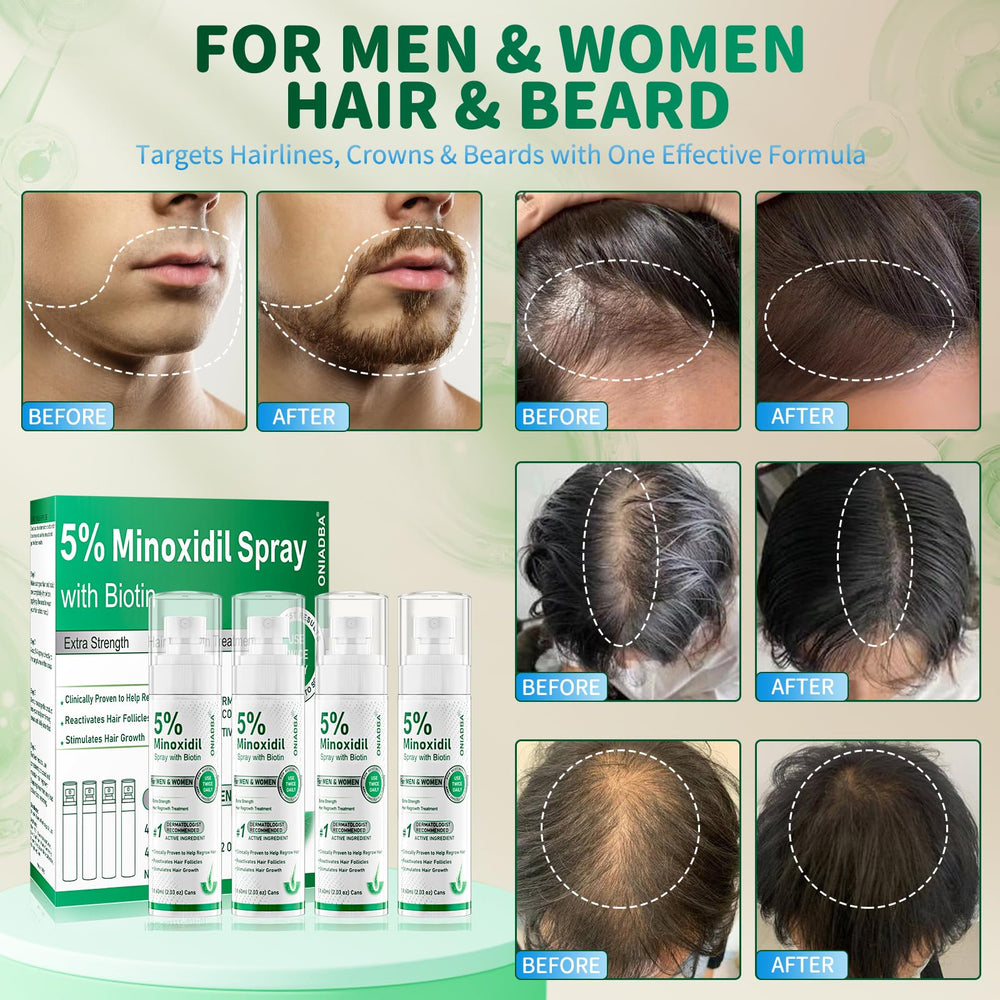 ONIADBA minoxidil application to scalp demonstrates easy daily use.