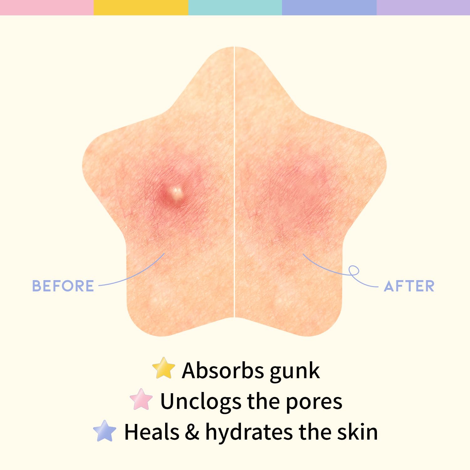 OOTD Star Pimple Patches pastel colors suit teen skincare routines.