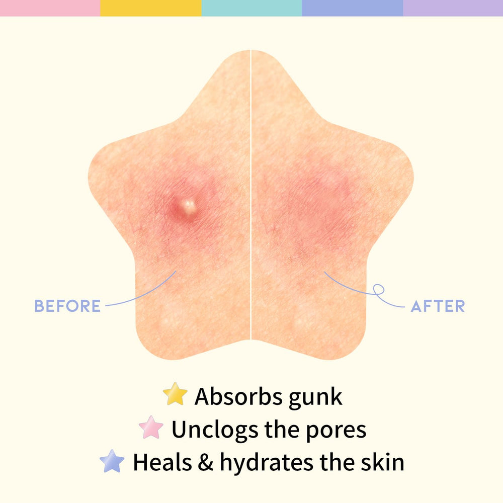 OOTD Star Pimple Patches pastel colors suit teen skincare routines.