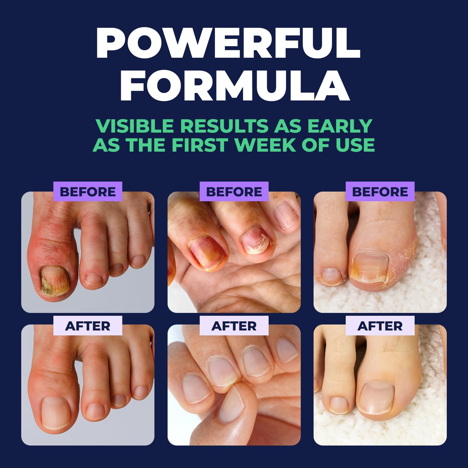 Orivelle Nail Fungus Pen clear-discoloration focus helps nails look more polished.