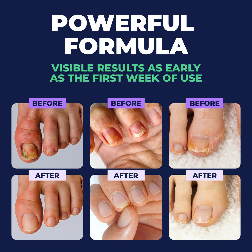 Orivelle Nail Fungus Pen clear-discoloration focus helps nails look more polished.