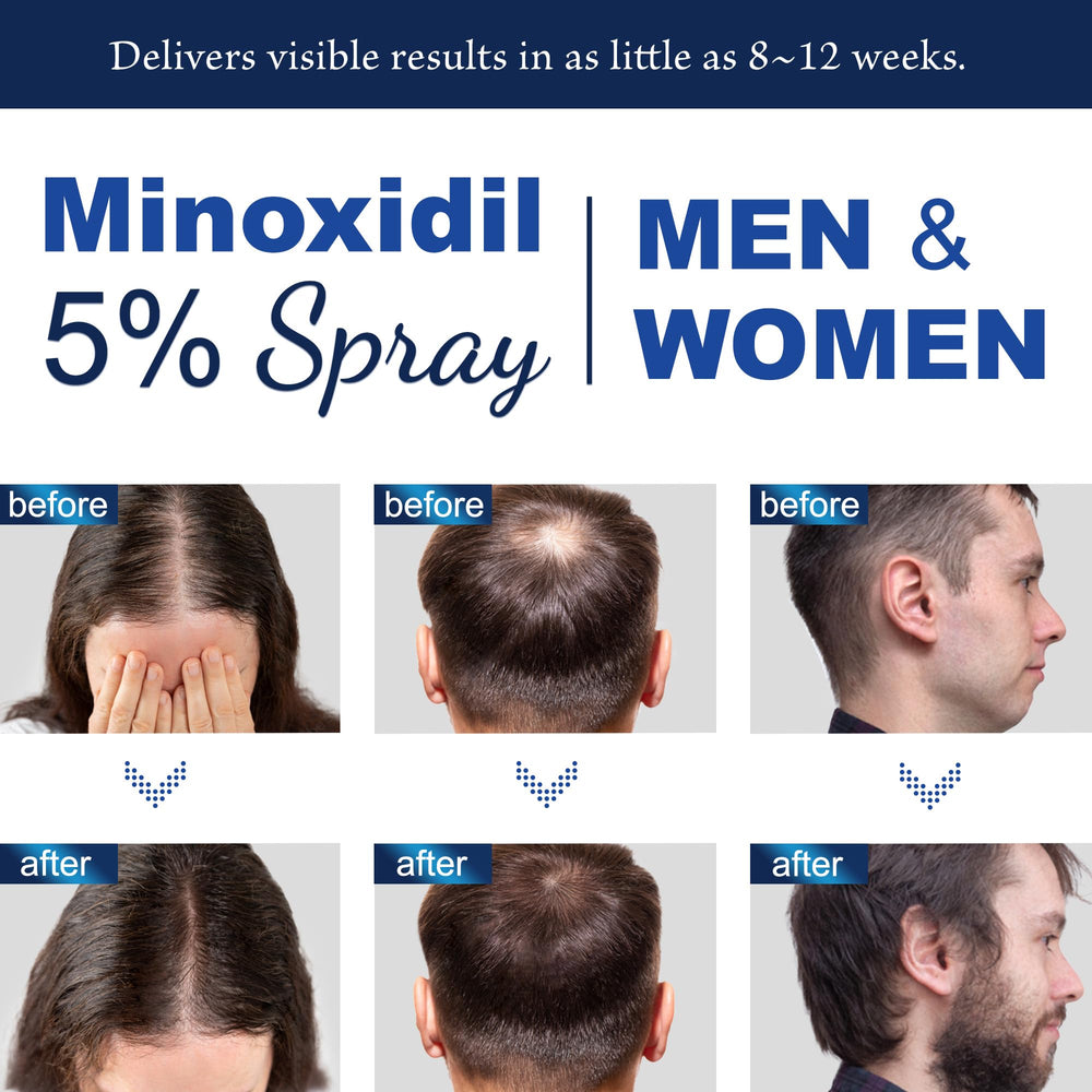 OSIMOON Minoxidil 5% label close-up of active ingredients.