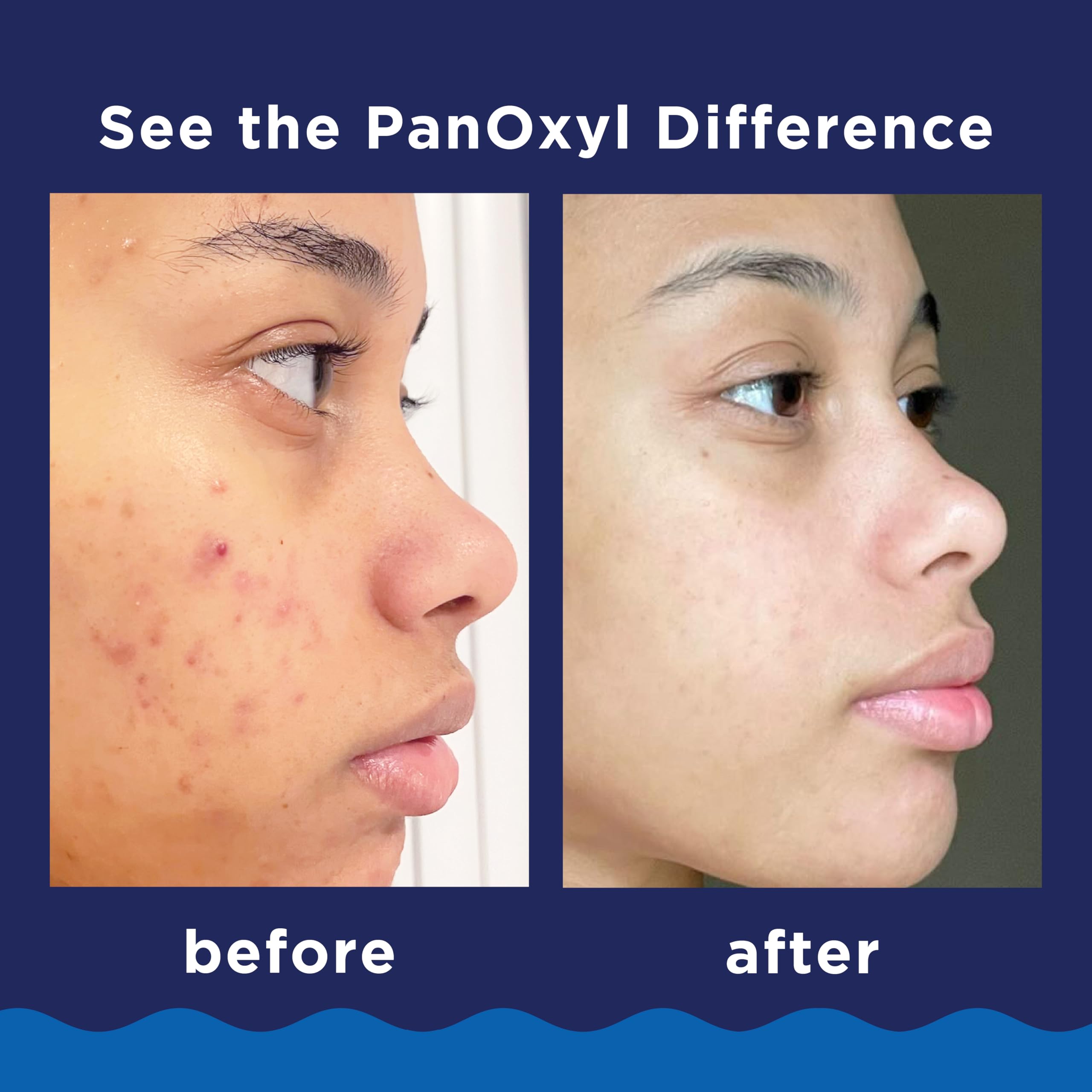 PanOxyl wash being massaged on face to reduce acne-causing bacteria