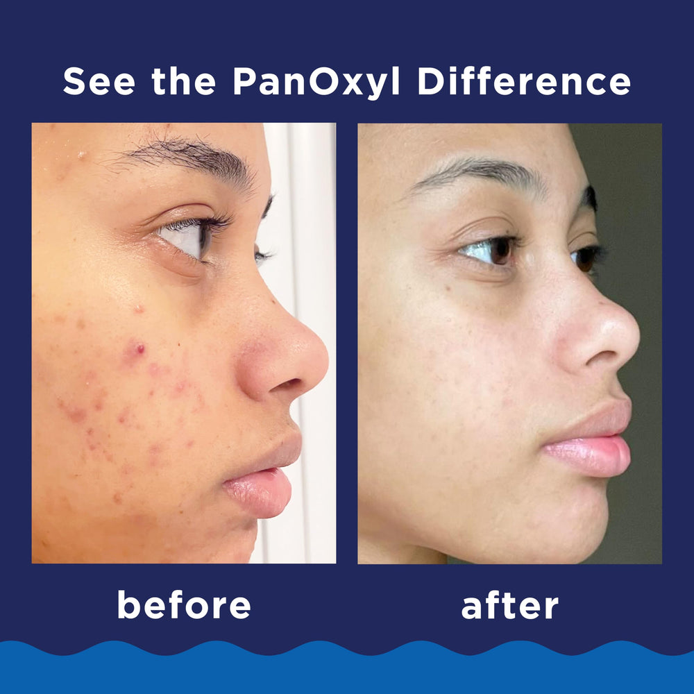 PanOxyl wash being massaged on face to reduce acne-causing bacteria