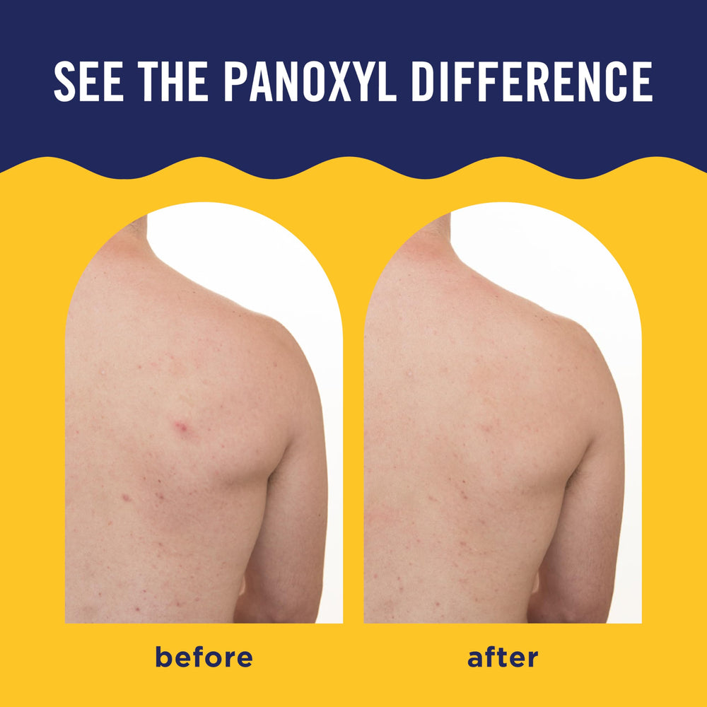 PanOxyl mist texture mid-air showing fine spray for quick-drying benefit