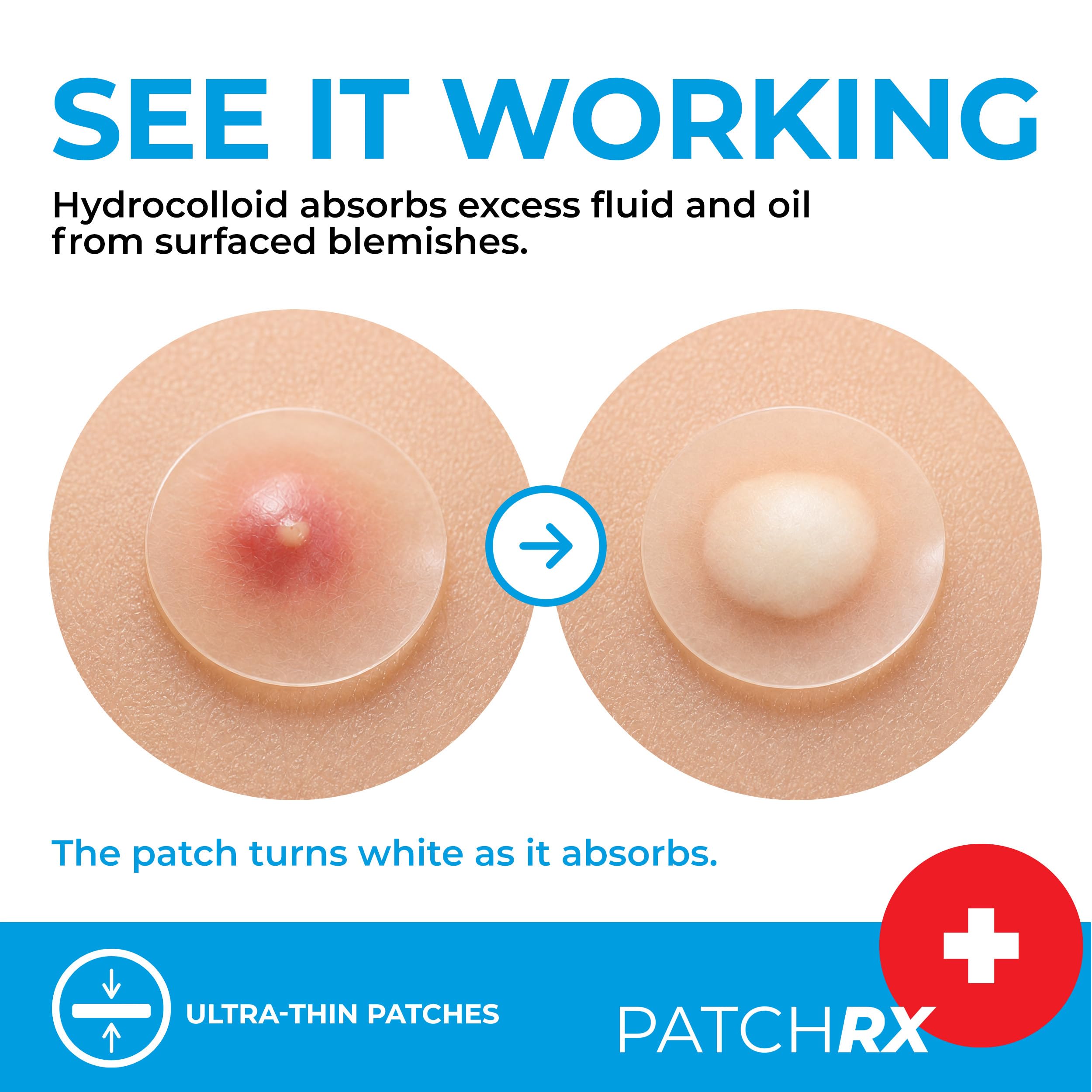 PatchRx clear hydrocolloid patch applied on facial blemish highlighting discreet coverage