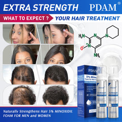 Pdam minoxidil-foam-men-women-use demonstrates universal hair support for thinning areas.