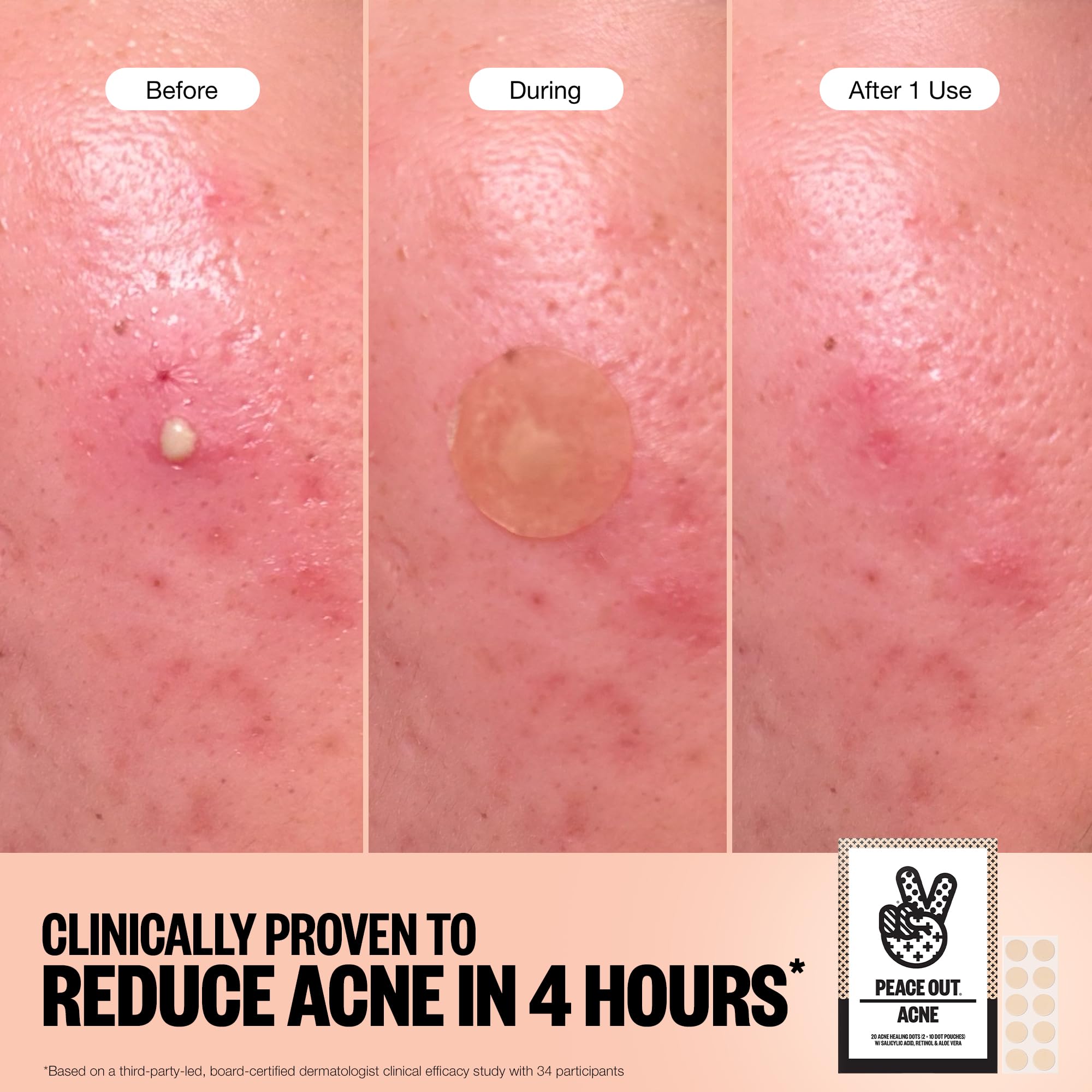 PEACE OUT Acne Healing Dots close-up highlights hydrocolloid texture absorbing impurities
