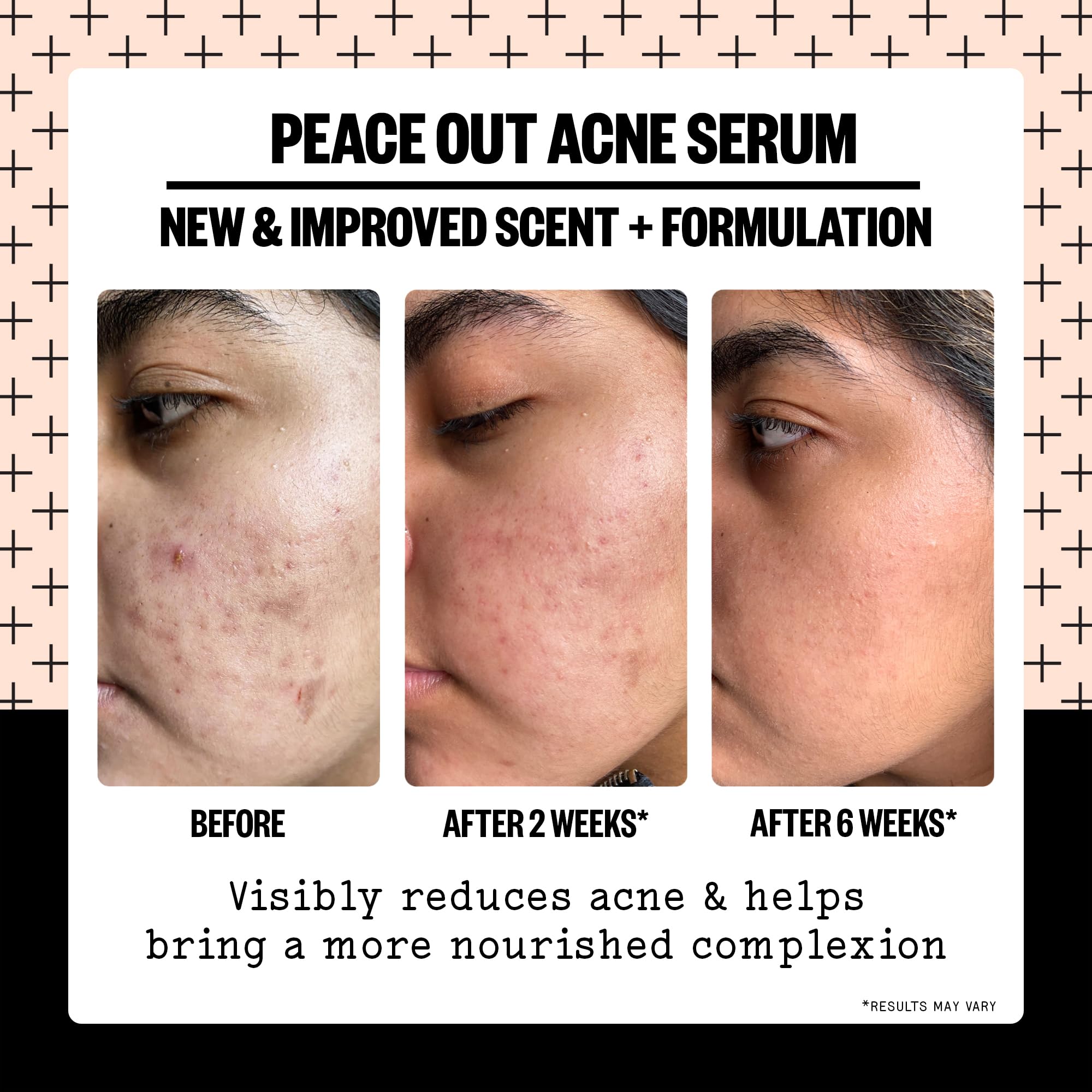 Peace Out Acne Serum packaging-front highlighting vegan, clean ingredients