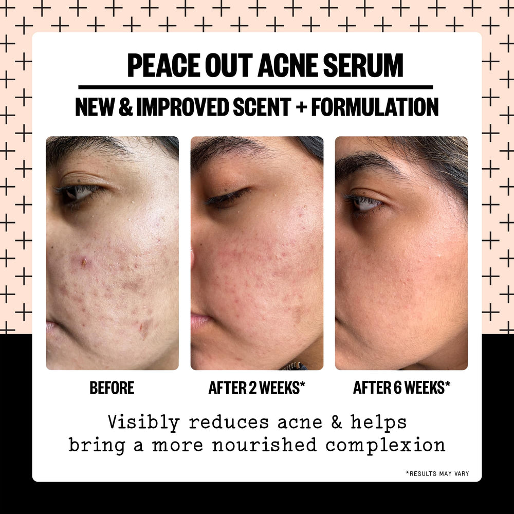 Peace Out Acne Serum packaging-front highlighting vegan, clean ingredients
