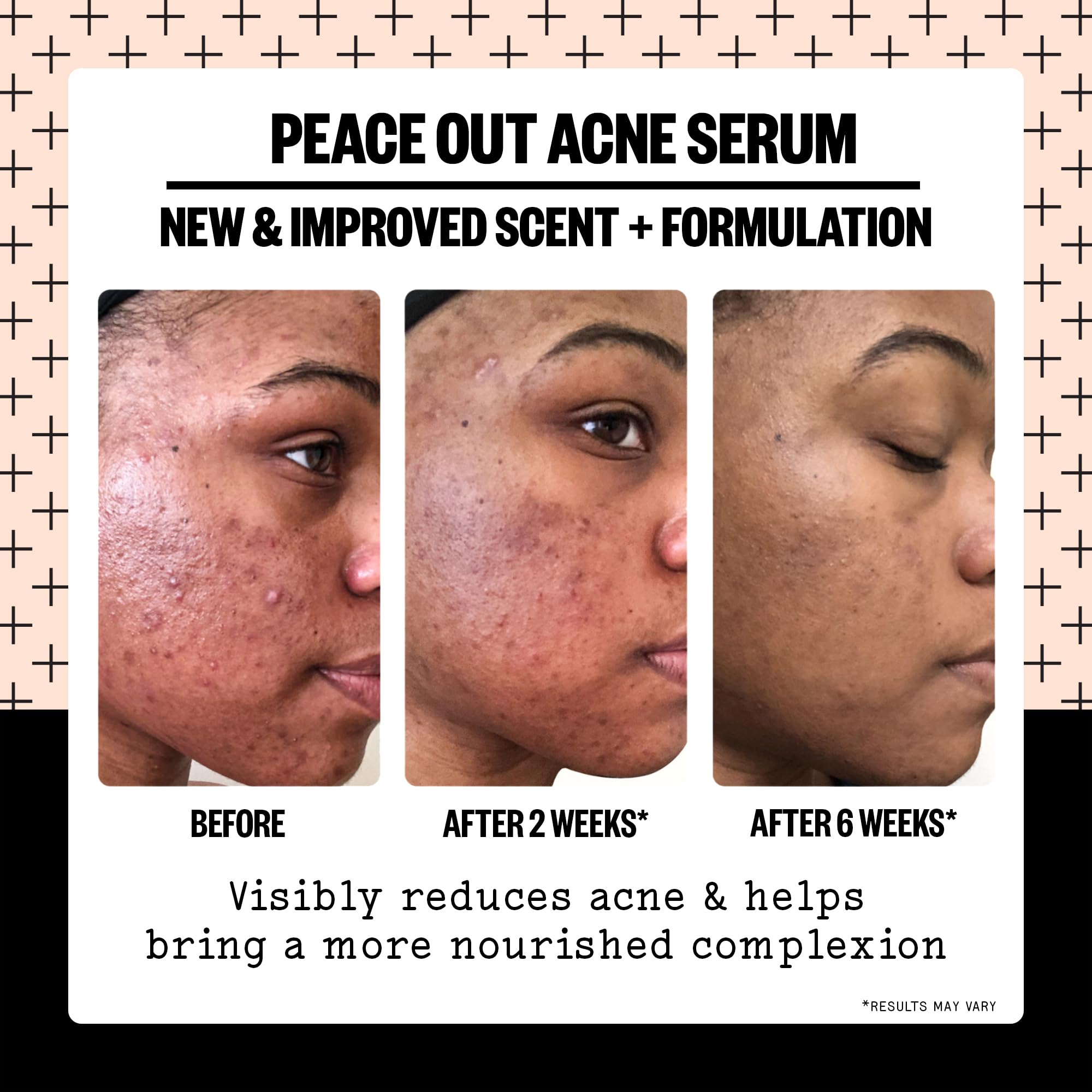 Peace Out Acne Serum spot-application during breakouts on clean skin