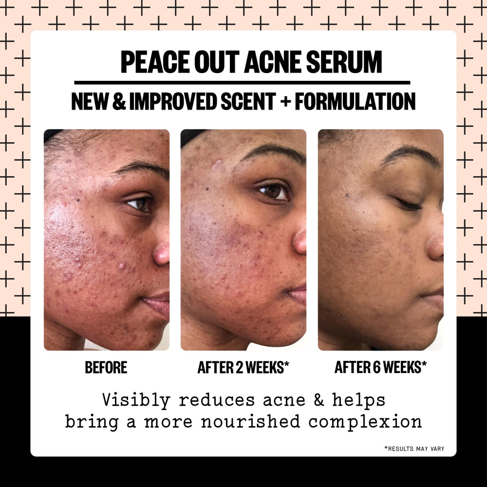 Peace Out Acne Serum spot-application during breakouts on clean skin
