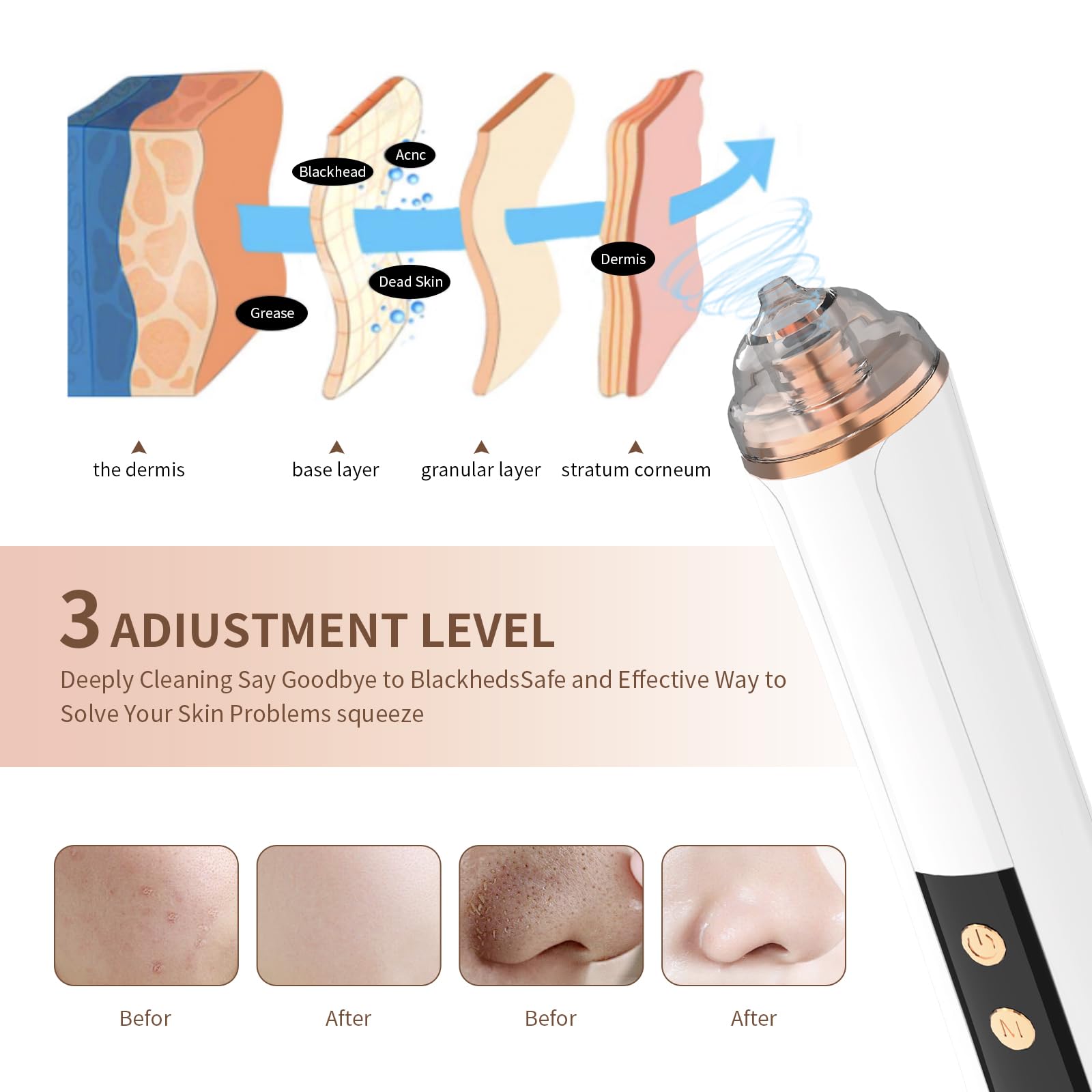 PENSVOX blackhead vacuum suction levels close-up for customizable pore cleaning.
