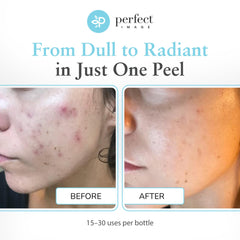 Perfect Image Glycolic 30% Gel Peel with green tea extract highlights antioxidant skin support.