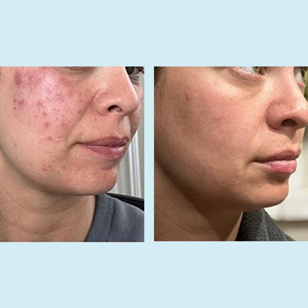 Perfect Image Glycolic 50% Peel in-use treatment demonstrates salon-grade application.