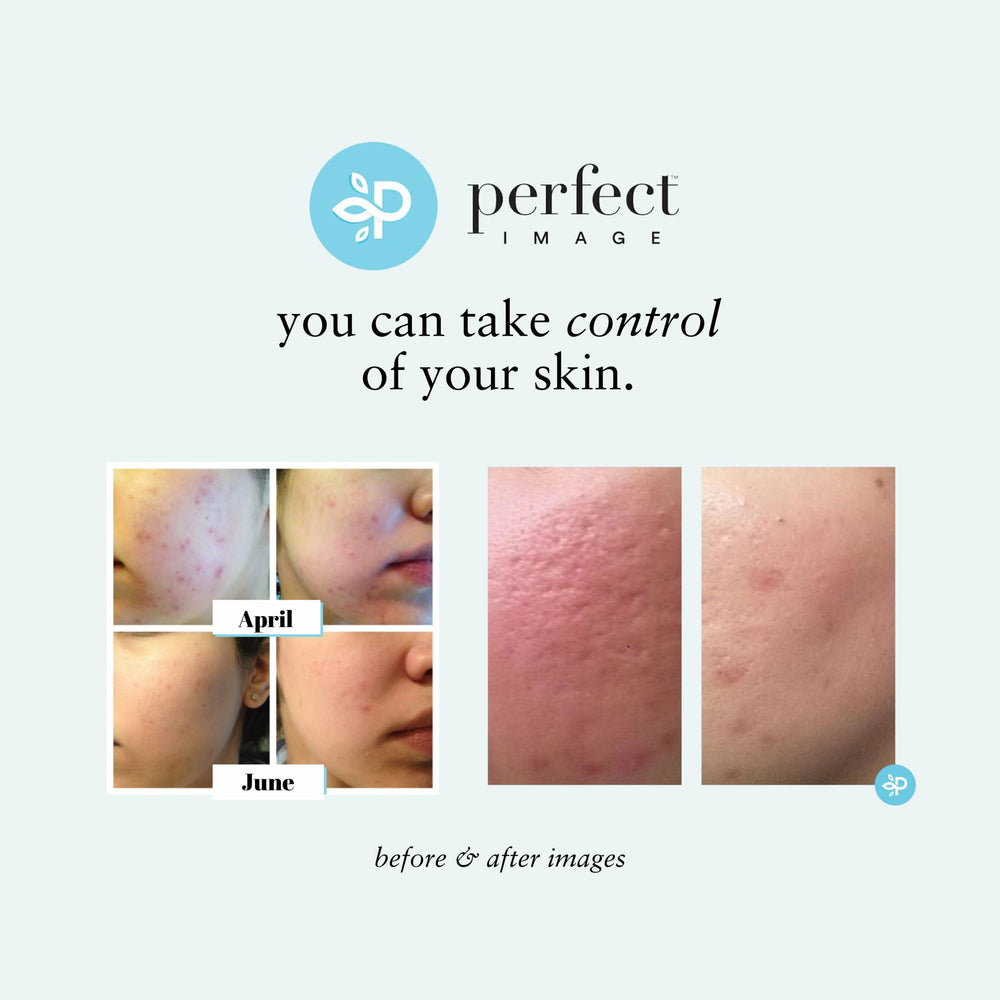 Perfect Image Lactic 50% Gel Peel features green tea and cucumber for revitalizing skin