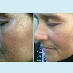 Perfect Image Lactic 50% Gel Peel ingredients highlight kojic acid, bearberry, licorice brightening