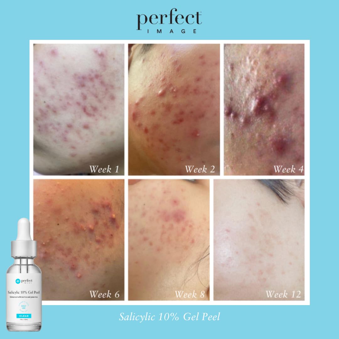 Perfect Image Salicylic 10% Gel Peel cucumber and chamomile soothing components pictured.