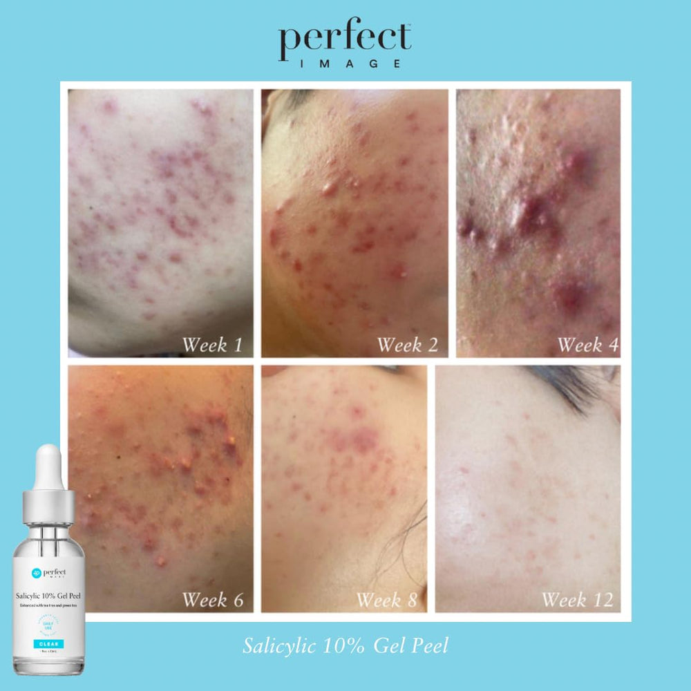 Perfect Image Salicylic 10% Gel Peel cucumber and chamomile soothing components pictured.