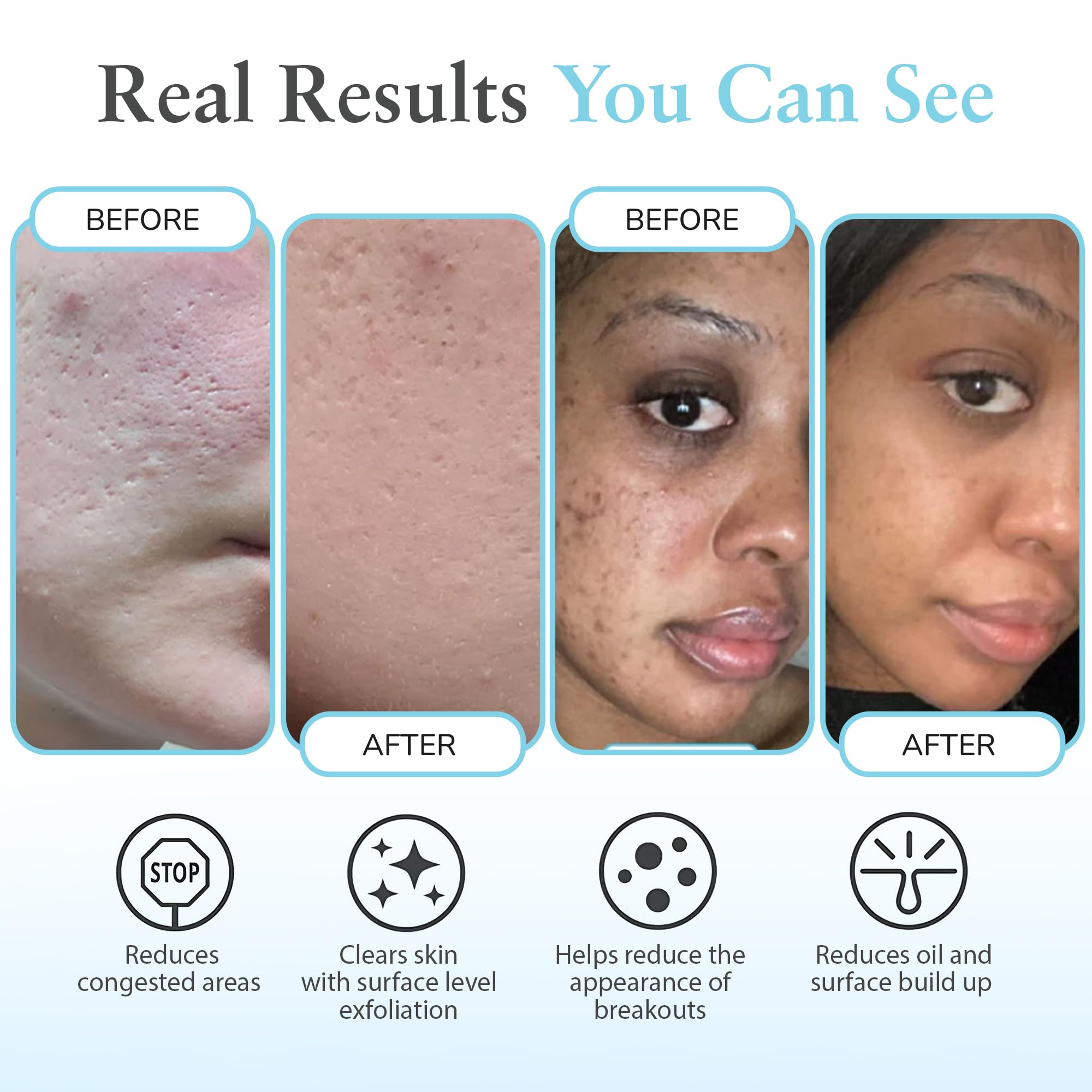 Perfect Image Salicylic 10% Gel Peel texture close-up demonstrates gentle exfoliation for smoother skin.