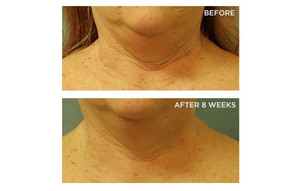 Perricone MD neck-chest cream application close-up highlights creamy texture for even-toned, hydrated skin.