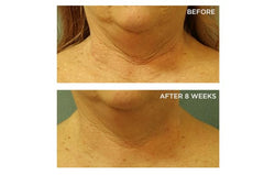 Perricone MD neck-chest cream application close-up highlights creamy texture for even-toned, hydrated skin.