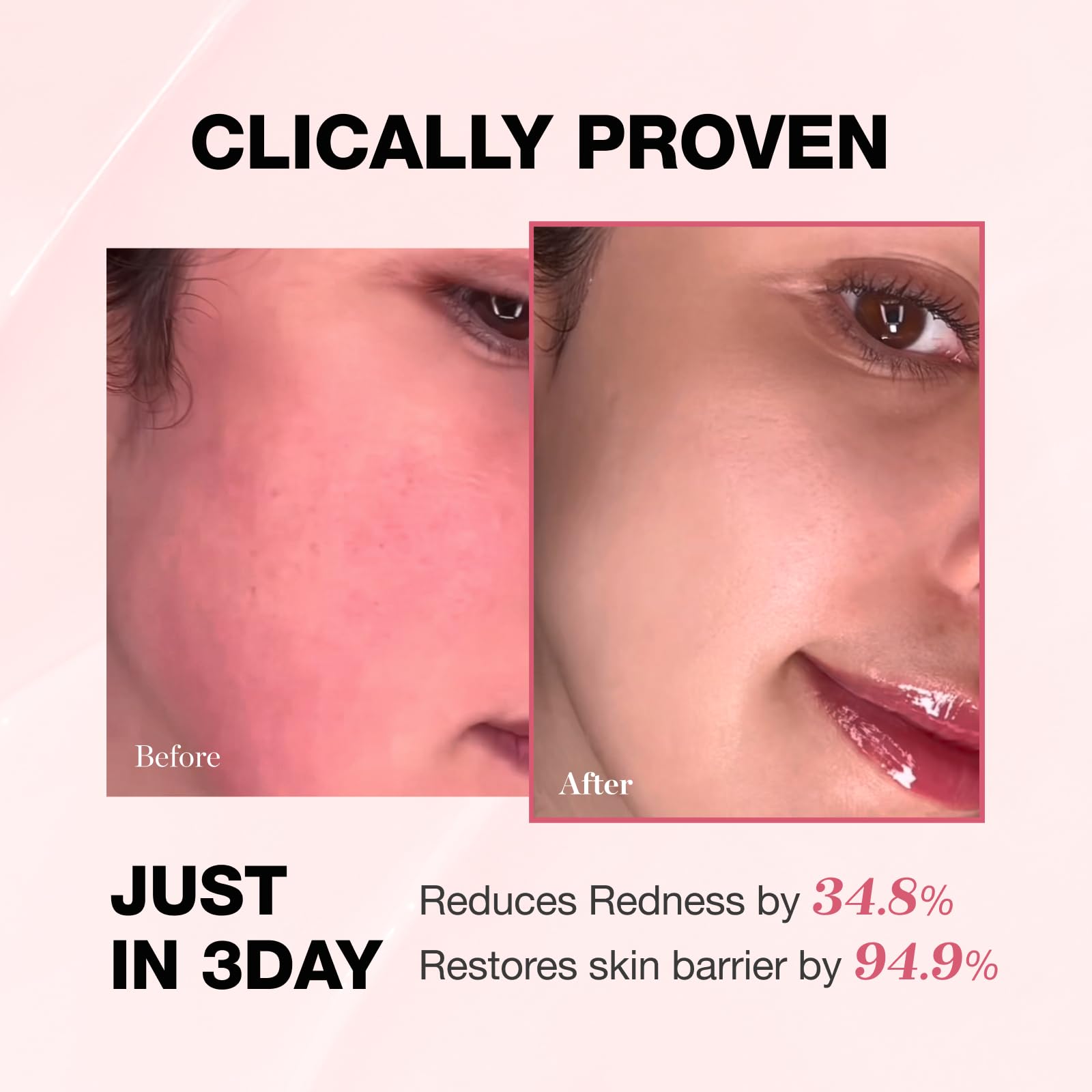 PHYSIOGEL NEA seal acceptance badge signals dermatologist-approved redness relief considerations.