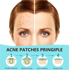 PICcircuit pimple patches invisible-on-skin demonstrate matte finish blending with complexion.