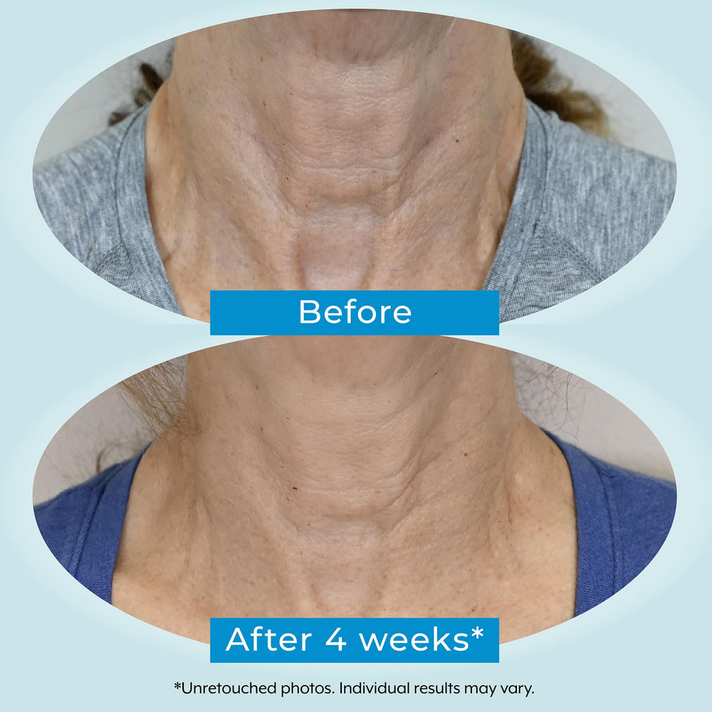 Plexaderm Hyaluronic acid moisture boost image—helps skin stay hydrated.