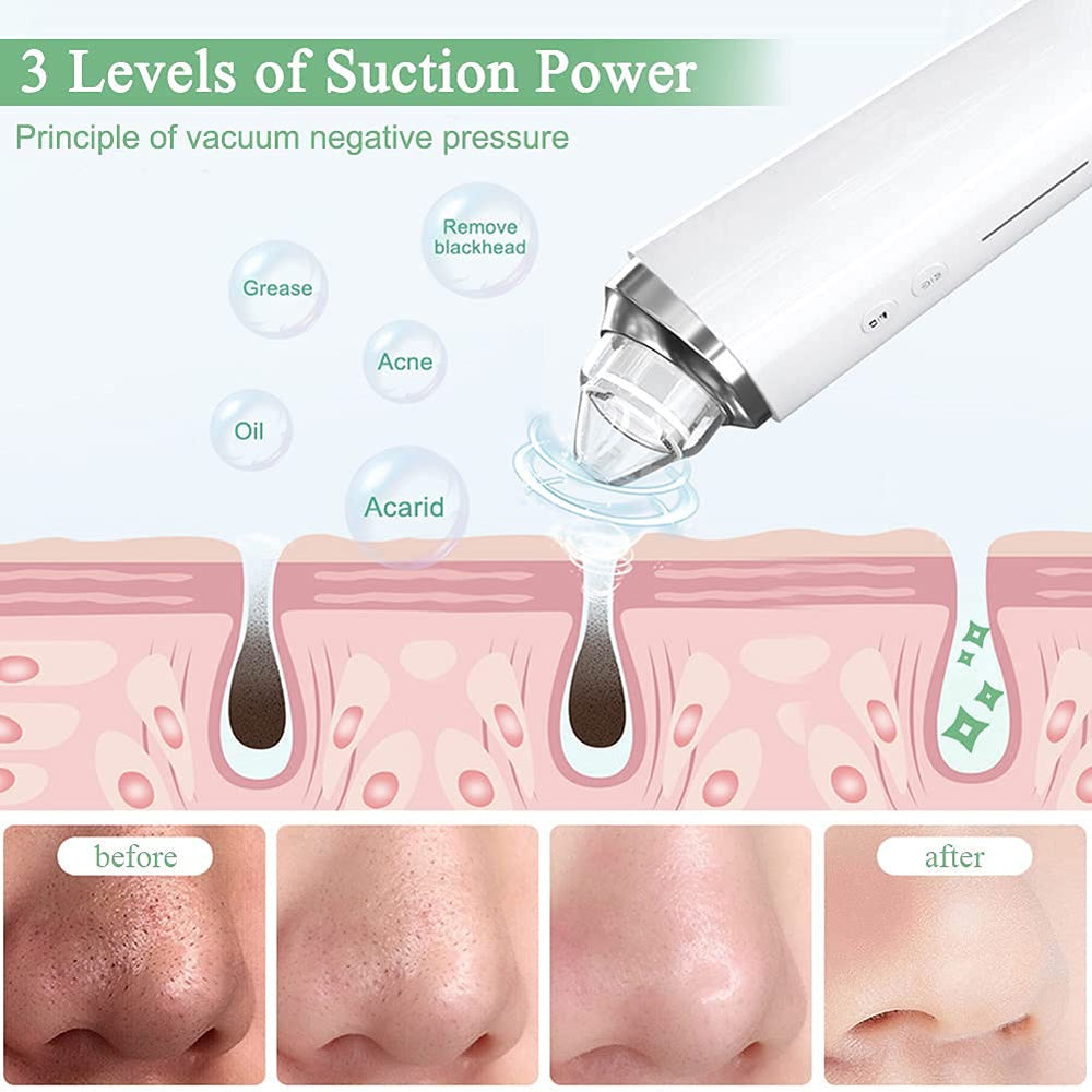 Prabensei blackhead remover kit includes six probes for versatile pore cleaning.