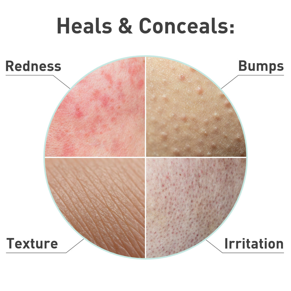 Rosacare Serum with hyaluronic acid delivers deep hydration.